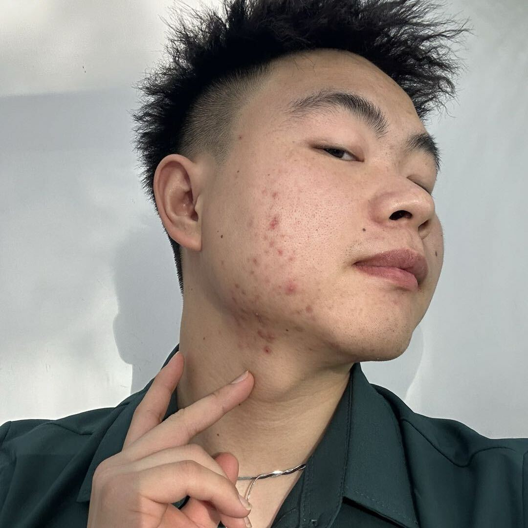 涛哥不长痘